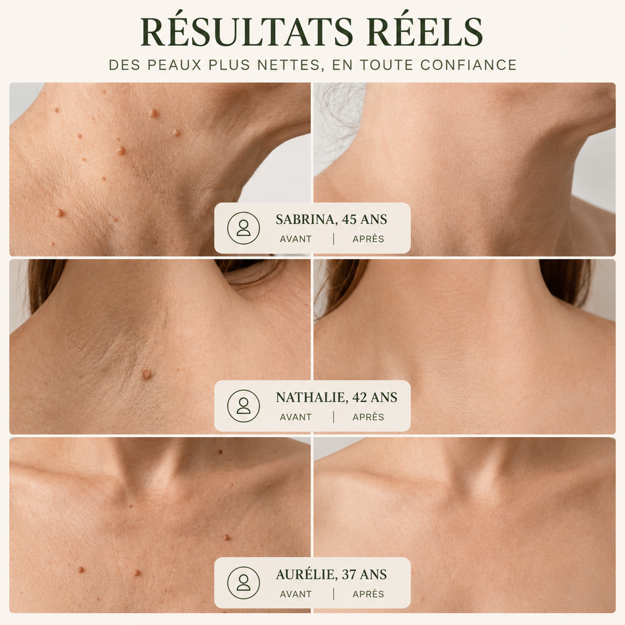 Patch LUMAPEAU — Micro-aiguilles Anti-Imperfections
